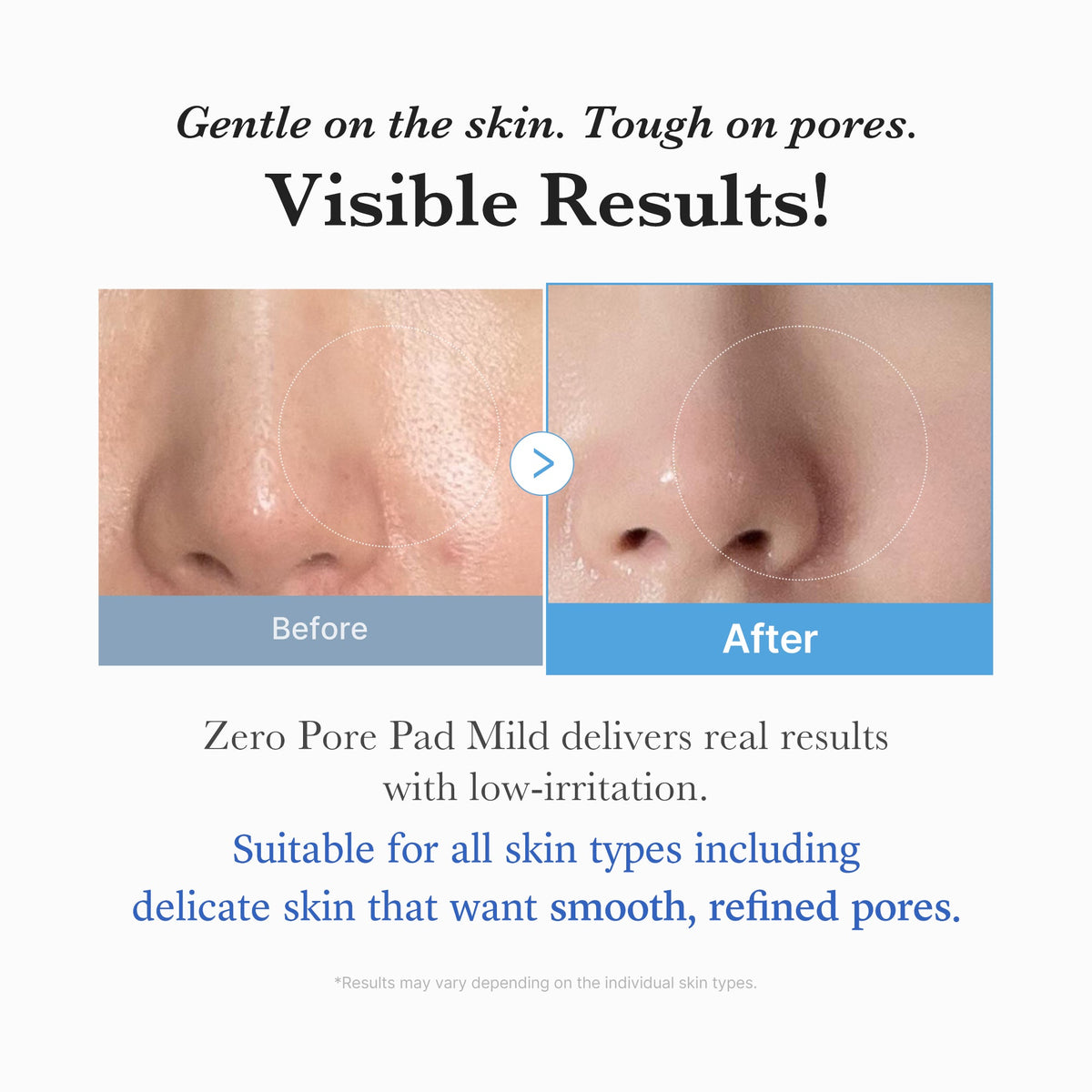 zero-pore-madecassoside-pads-mild-y4 04_6357f9f9-483b-4891-82c6-a58d336e62c8.jpg